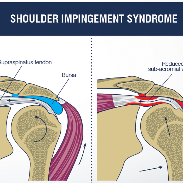The Shoulders Are Intermittently Trapped And Compressed During Shoulder Movements Impingement Syndrome Also Called Subacromial